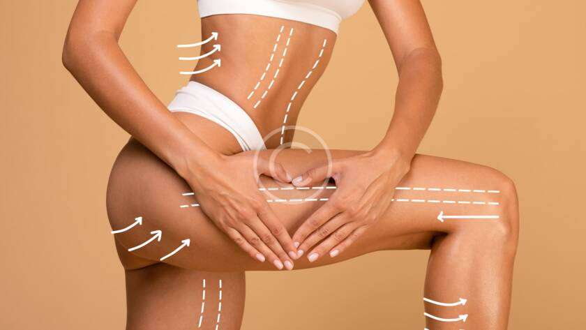 Laser Hair Removal