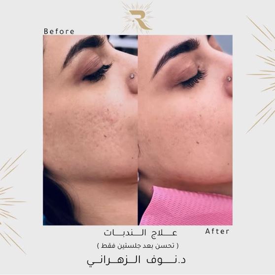 تنظيف البشرة